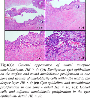 Unicystic Ameloblastoma Histology Unicystic Ameloblastoma With Varying unicystic-ameloblastoma-histology-unicystic-ameloblastoma-with-varying